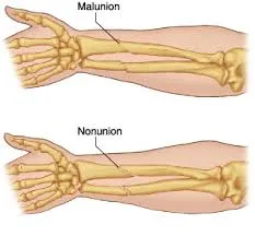 Nonunion Malunion Treatment image 2